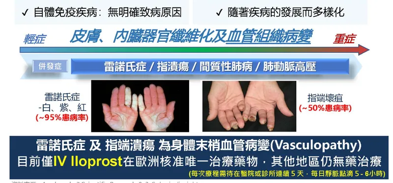 國邑藥品科技系統性硬化症相關雷諾現象與指端潰瘍